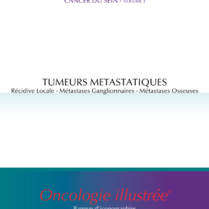 Cancer du sein - volume 3 : Tumeurs métastatiques (récidive locale, métastases ganglionnaires, métastases osseuses)